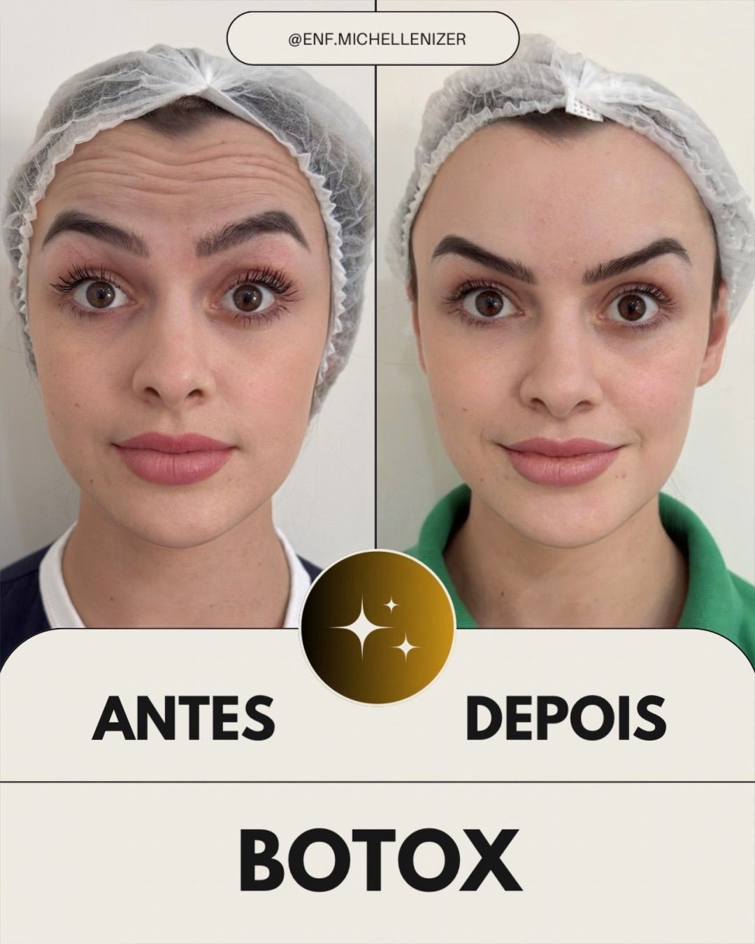 Toxina Botulínica