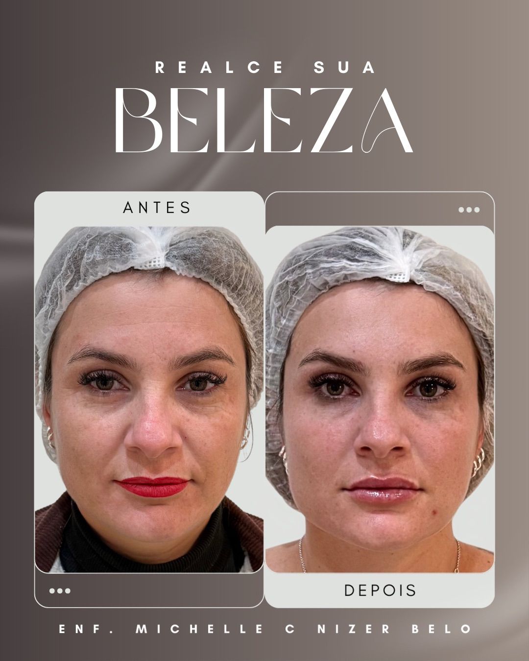 Harmonização Facial