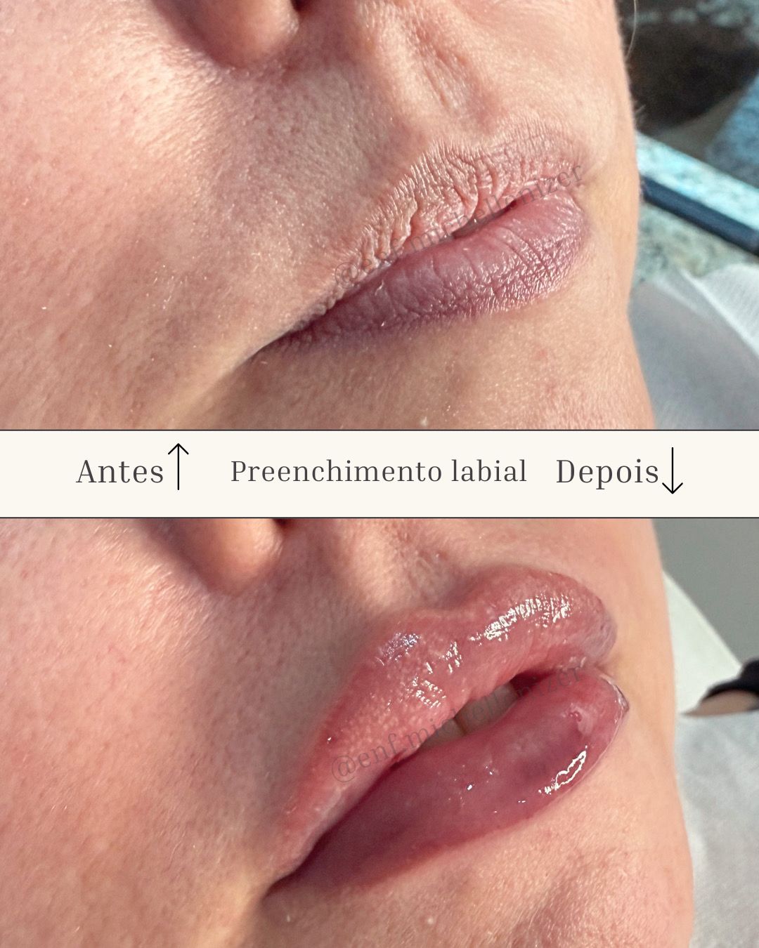 Preenchimento Labial
