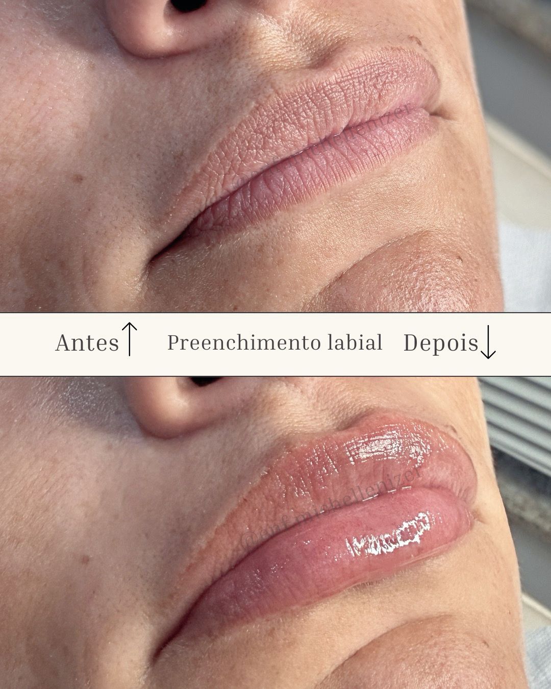 Preenchimento Labial