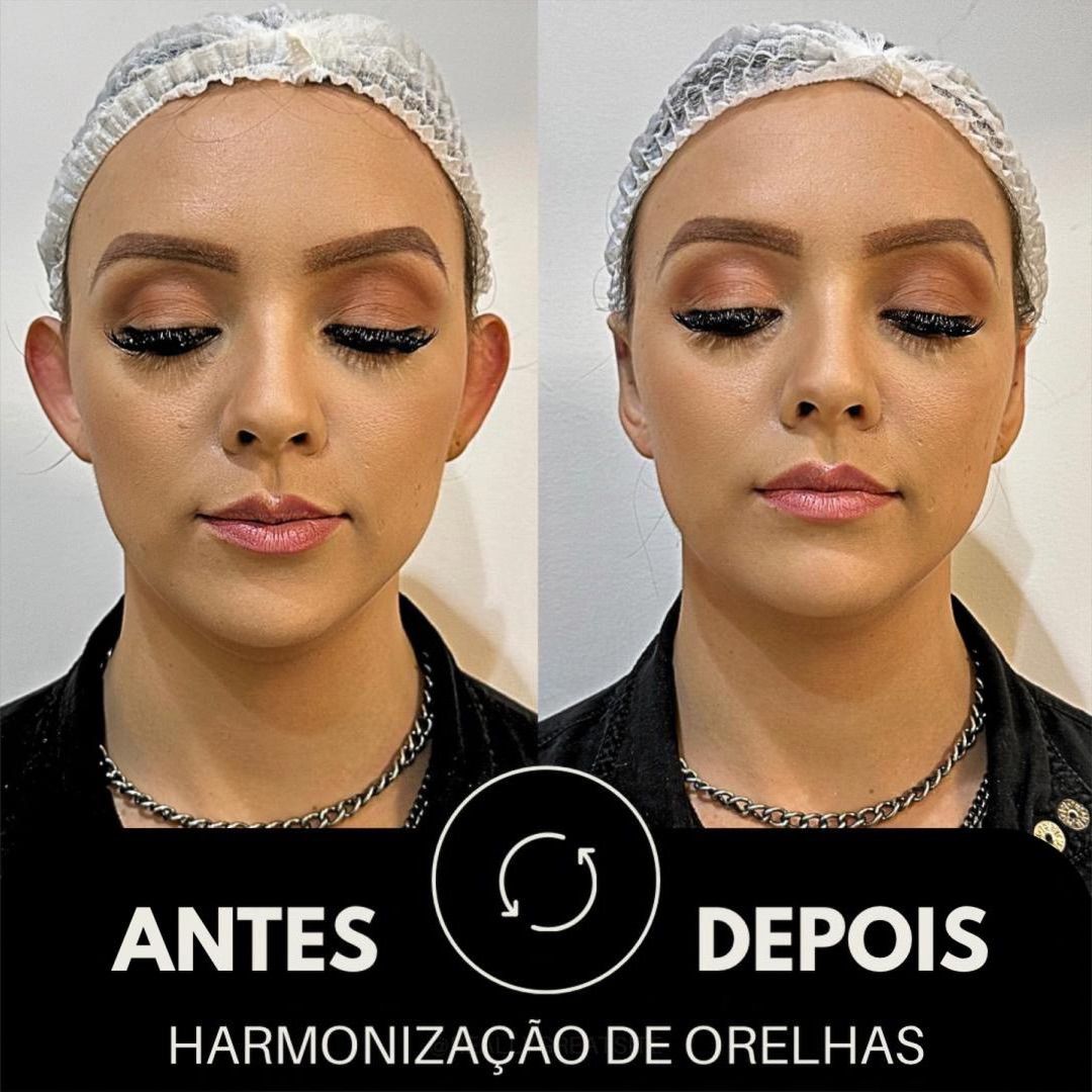Harmonização de Orelhas